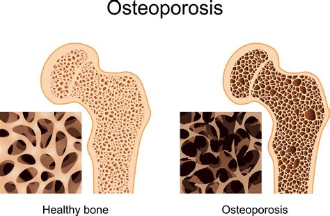 What Causes Osteoporosis?
