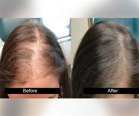 AG Clinics :: best hair transplant clinic in jalandhar, hair transplant ...