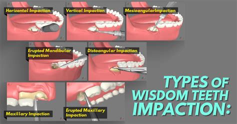 Image result for Wisdom Teeth Impaction Types