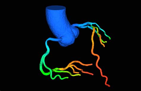 CT-FFR Enhancing Selectivity Precision in Cardiac Patient Care