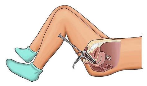 Dilation and Curettage (D&C) : डाइलेशन और क्यूरेटेज सर्जरी क्या है ...