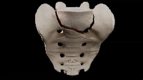 Sacral Fractures: Classification, Symptoms, Diagnosis, and Treatment