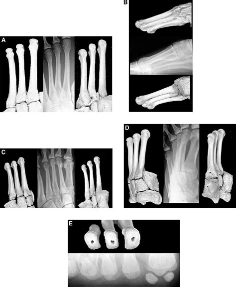 Radiographic Anatomy of the Foot and Ankle—Part 4. The Metatarsals