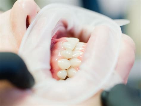 Infected Tooth Extraction Procedure 的图像结果