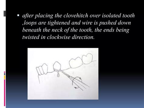 Image result for Intermaxillary Fixation