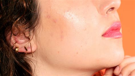 Acne Around Nose