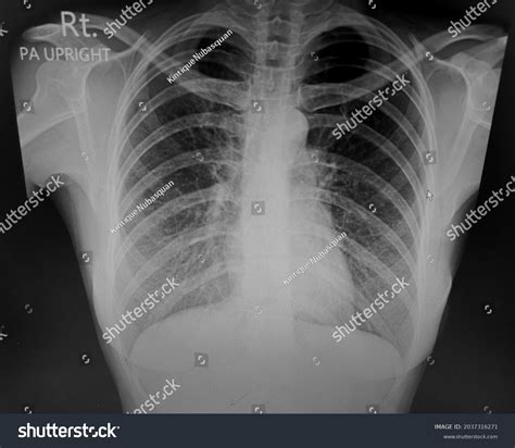 Plain Chest Xray Shows Normal Lungs Stock Photo 2037316271 | Shutterstock