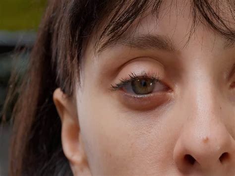 10 Natural Ways To Get Rid Of Bags Under The Eyes | TheHealthSite.com