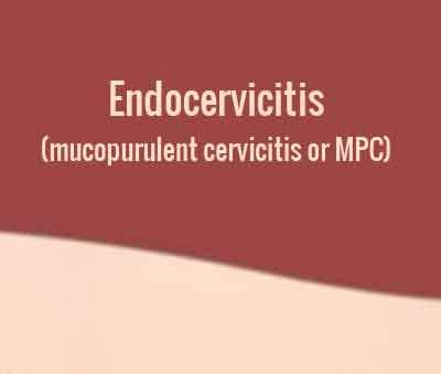 Endocervicitis (mucopurulent cervicitis or MPC)-Standard Treatment ...