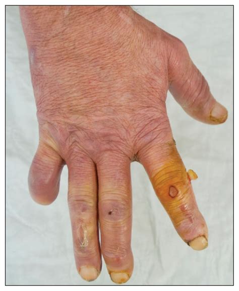 arthritis, progressive maculopapular rash and severe peripheral