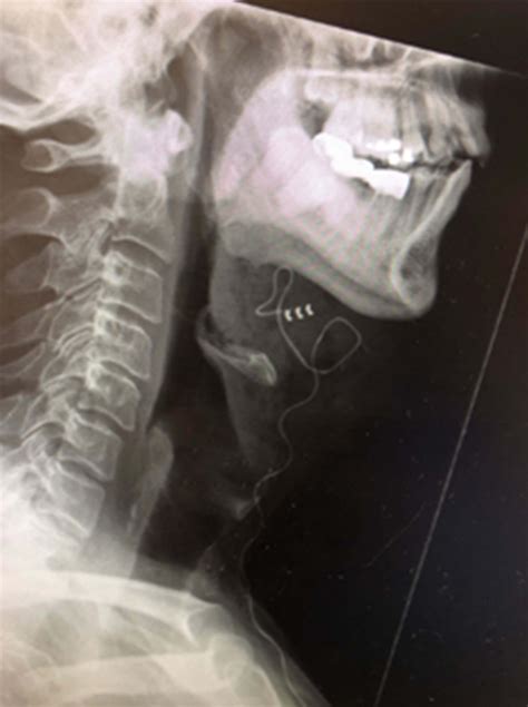 First UK hypoglossal nerve stimulation implant in the treatment for ...