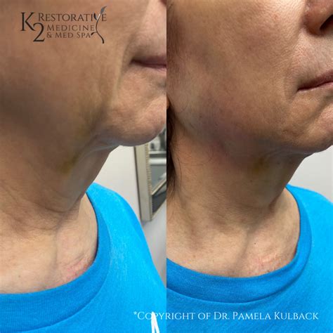 Threading Facelift Before and After 的图像结果