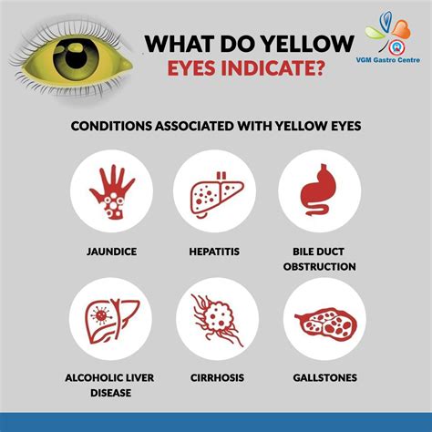 Yellow Eyes Jaundice