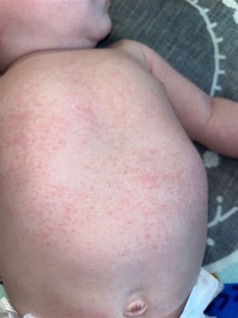 Abdominal Rash Baby