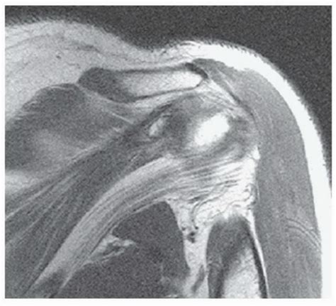 Image result for Subacromial Decompression Rotator Cuff Repair