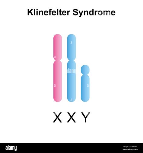 Xxy Syndrome Chromosomes Klinefelter's Syndrome The Lancet