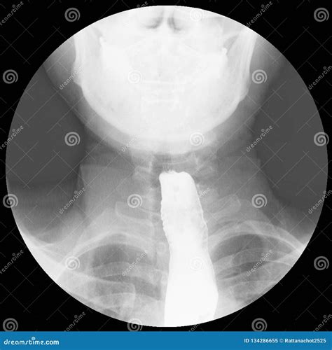 Barium Swallow Evidence of Achalasia at Distal Esophagus To EG Junction.Moderate Proximal ...