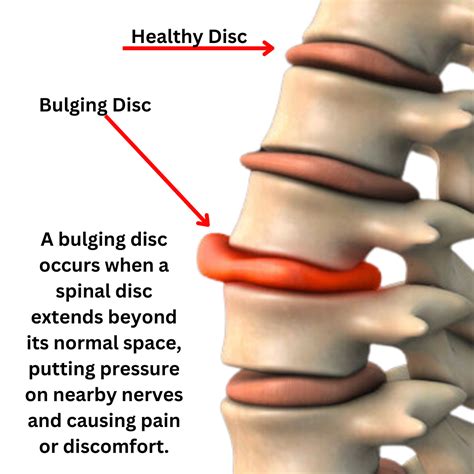 What is a Bulging Disc? Causes, Symptoms & Treatment | Brace Direct
