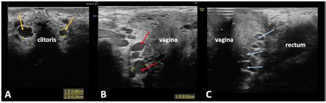 Management of Extra-Pelvic Varicose Veins of Pelvic Origin in Female ...