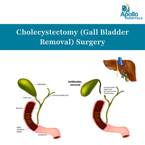 Cholecystectomy (Gall Bladder Removal) Surgery - Types, Cost, Procedure, and Recovery