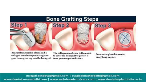 Bone graft materials | Bone grafting in Implantation | Periodontal surgeries | types of bone ...