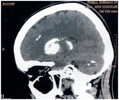 Rare Forms of Hereditary Hypoparathyroidism: Delayed Diagnosis Due To ...