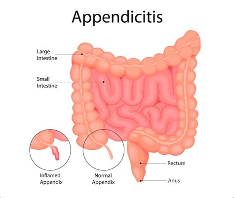 Appendicitis is an inflammation of the appendix anatomical illustration ...