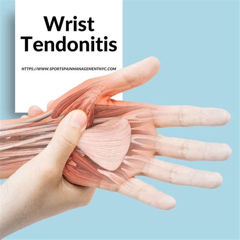Wrist tendonitis treatment nyc – Artofit