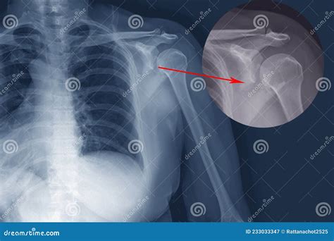 X-ray Shoulder Fracture Posterior Half of Glenoid with Posterior ...