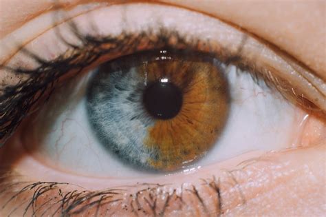 My friend's iris is split in half | Heterochromia eyes, Different colored eyes, Beautiful eyes color