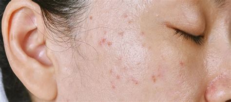 How to remove whiteheads: Understanding causes and prevention | The ...