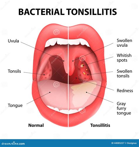 Bacterial Tonsillitis Vs Viral Tonsillitis