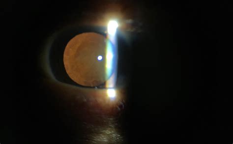 Remidio PSL D20 | Hand Held Portable Slit Lamp