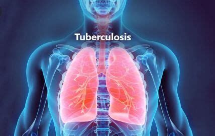Double Therapy promising treatment of Tuberculosis with C. Difficile ...