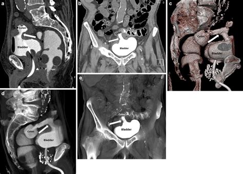Image result for Cystogram Procedure for CT Scan