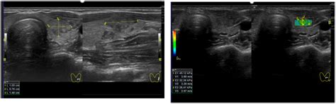 Shear Wave Elastography and Thyroid Imaging Reporting and Data System ...