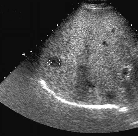 Hepatic Pseudotumor Due To Nodular Fatty Sparing: The Diagnostic Role of Opposed-Phase MRI | AJR