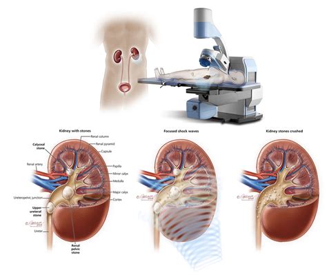 What Is Lithotripsy
