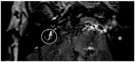 Endolymphatic Hydrops Magnet Resonance Imaging in Ménière’s Disease ...