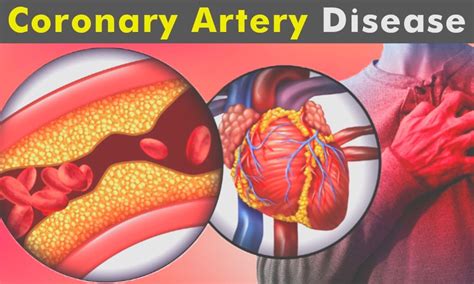 Switching to cangrelor in CAD patients pretreated with ticagrelor safe ...
