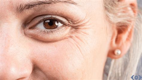 How to Eliminate Fine Lines Under Eyes? Causes & Treatments - Perfect Eyes Ltd