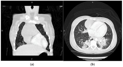 Intrathymic Hemagioma: A Challenging Case Report with Special Focus on ...