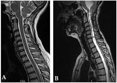 Decoding Chiari Malformation and Syringomyelia: From Epidemiology and Genetics to Advanced ...