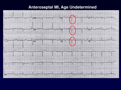Anterior Infarct Age Undetermined