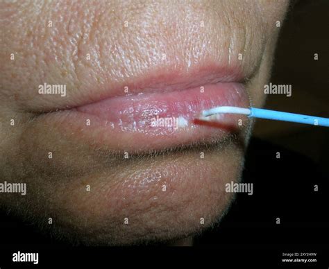 Actinic cheilitis lesions a patient's lip being treated with liquid ...