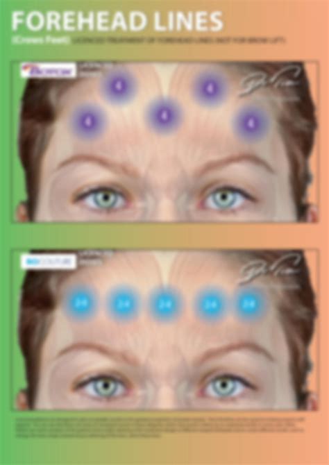 Image result for Botox Injection Patterns