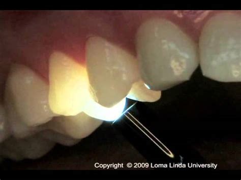 Image result for Transillumination Normal Head