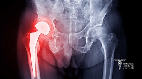 Hip Resurfacing Surgery Center Richardson and Dallas, Texas