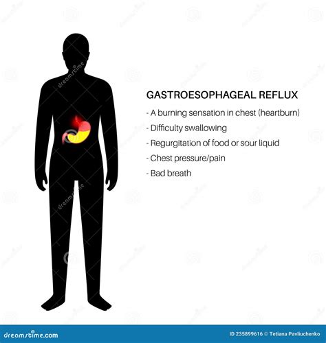 Can Coffee Cause Gastroesophageal Reflux Disease at Elaine Osborn blog