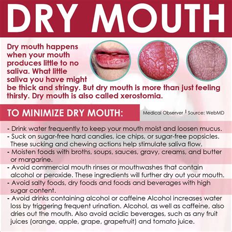 To Minimize Dry Mouth | Remedies for dry mouth, Dry mouth, Natural health remedies